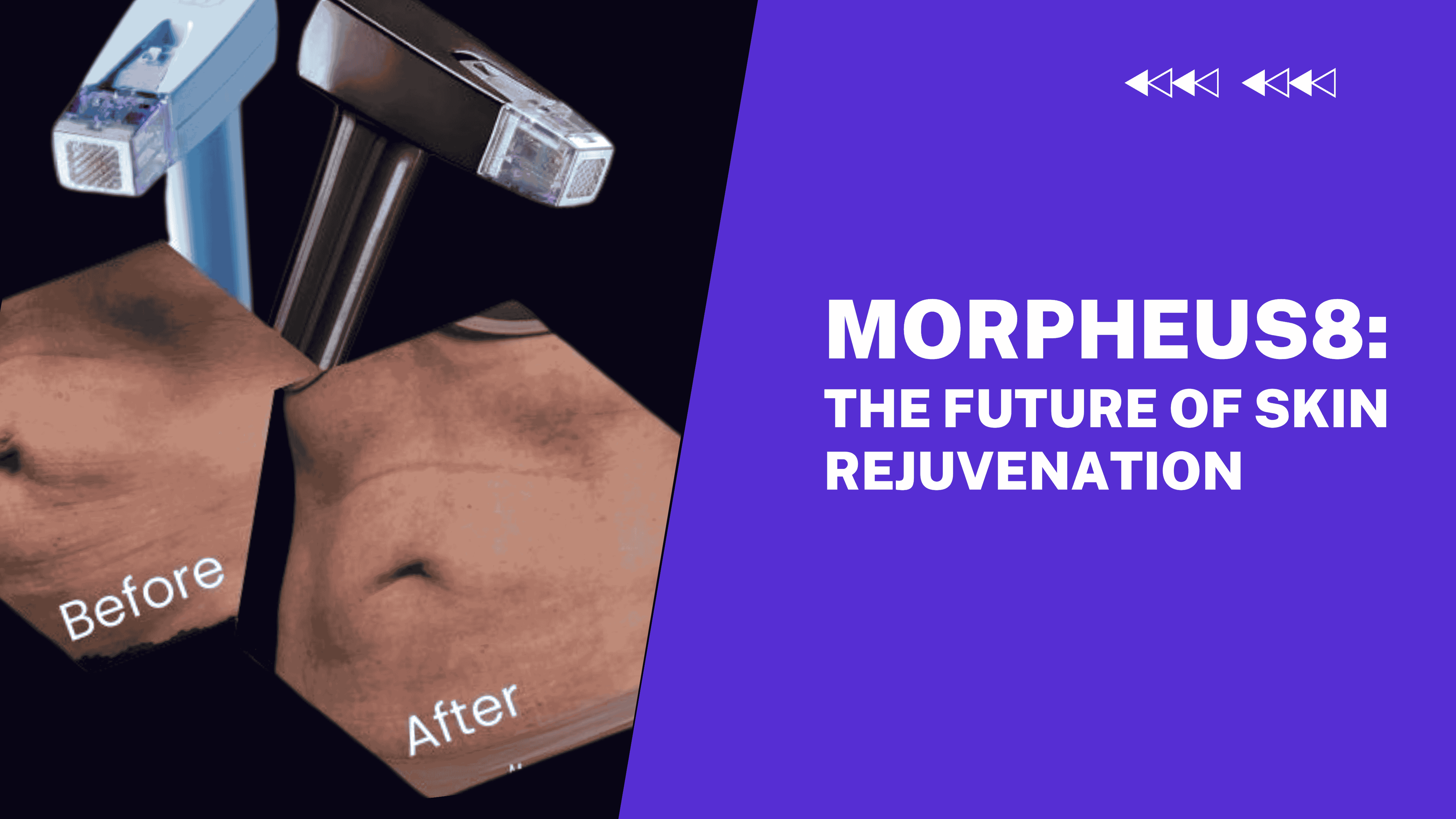 Morpheus8- The Future of Skin Rejuvenation