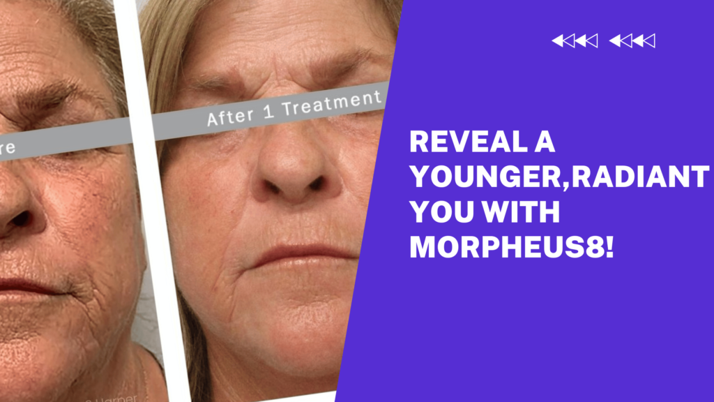 Reveal a Younger Radiant You with Morpheus8